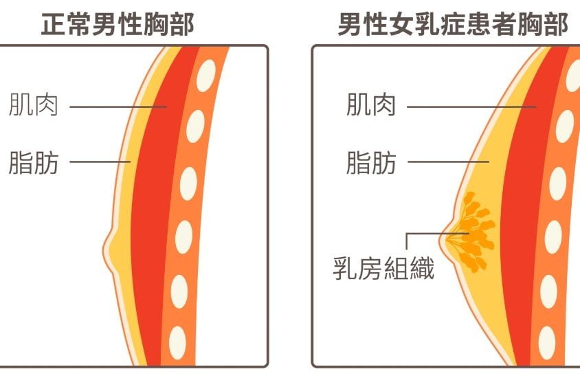 男性女乳症手術治療 兩種手術解決男性女乳症惱人症狀