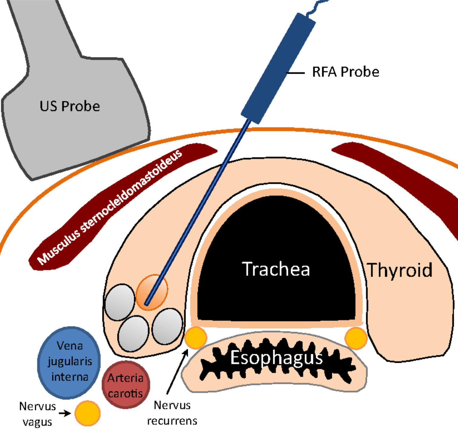 Thyroid RFA Vs. Conventional Thyroidectomy