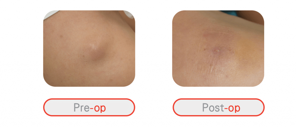 Epidermal Cyst Removal Doctor