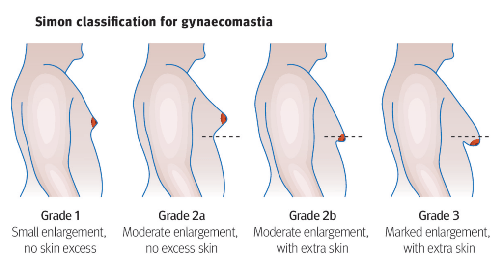 gynecomastia
